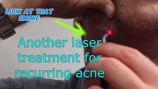 Laser treatment for acne A follow up [upl. by Kcid]