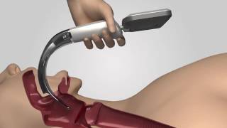 Video Laryngoscope iS3 L training video [upl. by Eryt475]