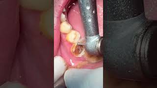 Tooth caries dentist dental viralvideo [upl. by Agosto]