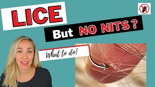 Lice But No Nits Video Tutorial [upl. by Babs602]