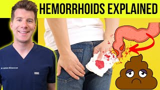 Doctor explains HEMORRHOIDS aka piles  Causes symptoms treatment amp prevention [upl. by Eltsryk619]