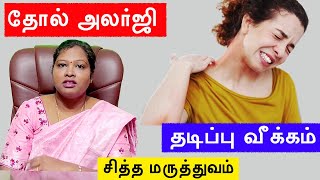 Siddha treatment for skin allergies Urticaria or Hives DrPIswarya Devi MDS [upl. by Hayse]