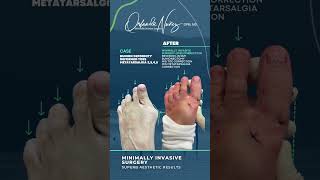 Minimally Invasive Surgery Bunion  Deformity Deformed toes  Metatarsalgia 2345 Before and After [upl. by Orpah]