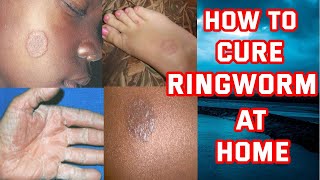 How To Cure Ringworm At Home  Ringworm Treatment [upl. by Shatzer]