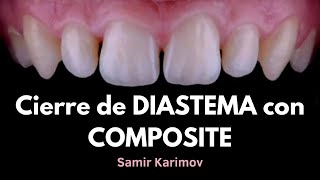 😷 Cierre de DIASTEMA con COMPOSITE  Samir Karimov [upl. by Aliahs31]