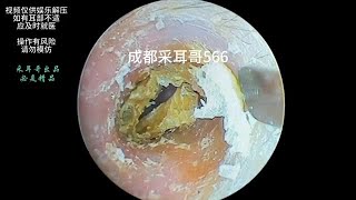 采耳哥Clean dry fungal slices in the ear ｜566 asmr earwax earwaxremoval drzhao [upl. by Sacksen]