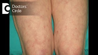 Purple lace type of discoloration on lower extremities signify Livedo Reticularis  Dr Nischal K [upl. by Ettigirb]