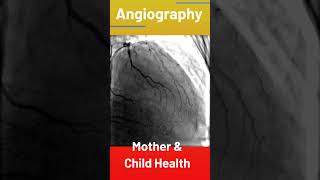 Coronary Angiography [upl. by Richards966]