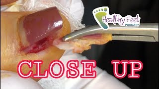 Close Up Ingrown Toenail Removal Painful Ingrown Nail [upl. by Akemad]