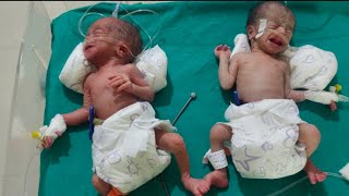 Today in my hospital there was a normal delivery of twin babies one weighing 900 gm weighing 700 gm [upl. by Adlare]