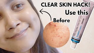 How to Use Tretinoin Correctly Before amp After Results [upl. by Nivert210]