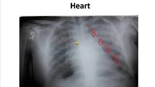 Mitralization of Heart  Chest Xray of Mitral Stenois [upl. by Yerggoeg]