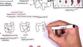 Colorectal Cancer  Overview [upl. by Eugaet]