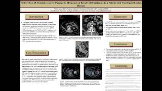 Positive GA68Dotatate PETCT scan for Pancreatic Metastasis of Renal Cell Carcinoma [upl. by Wehrle]