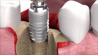 SIC invent Dental Implant Procedure SICmax implant insertion [upl. by Aivitnahs]