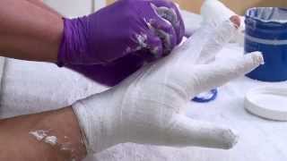 Changing a hand wrapping bandage after a burn injury [upl. by Anilef]