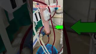 Dialyzer rupture hemodialysis ckdpatient hospital [upl. by Acirema]