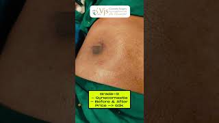 Transformative Results Grade3 Gynecomastia Before amp After  Procedure Benefits Confidence Boost [upl. by Wrennie988]