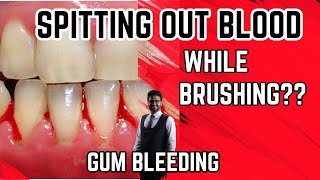 How to stop BLEEDING GUMS Blood from gums treatment [upl. by Pillyhp979]