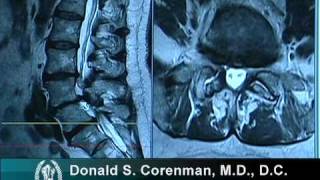 How to Read a MRI of Lumbar Degenerative Spondylolisthesis and Spinal Stenosis [upl. by Kavanaugh514]