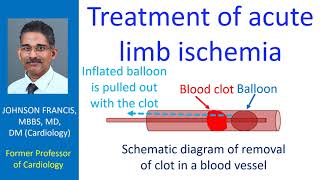 Treatment of acute limb ischemia [upl. by Huntley]