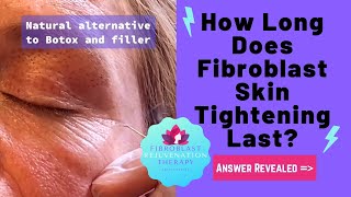 How Long Does Fibroblast Skin Tightening Last Answers Revealed [upl. by Joete938]