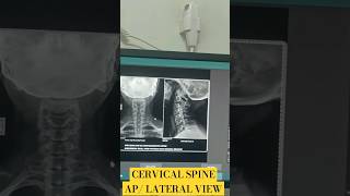 Cervical spine APLATERAL View xray xrays cervical cervicalpain viralreels radiologycareer [upl. by Wiggins508]