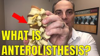 Ep61 What Does Anterolisthesis Of L5 Mean  Dr Walter Salubro Chiropractor in Vaughan [upl. by Anikat727]