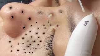 Big Cystic Acne Blackheads Extraction Blackheads amp Milia Whiteheads Removal Pimple Popping  707 [upl. by Arriat516]