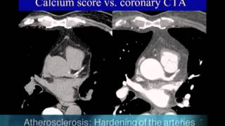 UCSF Radiology Calcium Scoring vs Coronary CTA Scan [upl. by Androw]