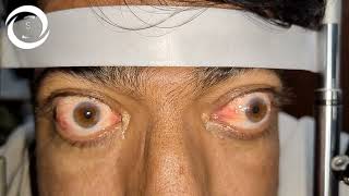 Thyroid Ophthalmopathy Sight Threatening Complications [upl. by Noemad]