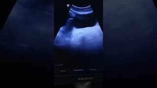 Left Adnexal simple cyst Ultrasound video shorts [upl. by Audrye222]