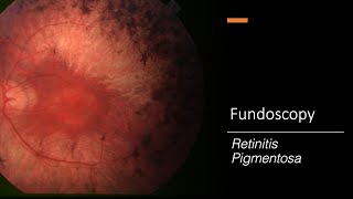 Retinitis Pigmentosa Fundoscopy [upl. by Myrilla]