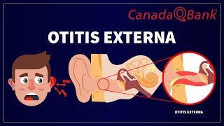 Otitis Externa [upl. by Custer]