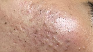 ACNE TREATMENT VU QUYNH MI  Blackheads On Boy Face 2024FULL [upl. by Esorbma]