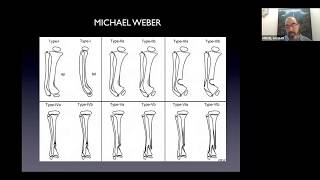 Pseudoartrosis Congénita de tibia y peroné [upl. by Cheng576]