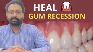 Gum Massage to Heal Receding Gums and Grow Gums Back [upl. by Dannel626]