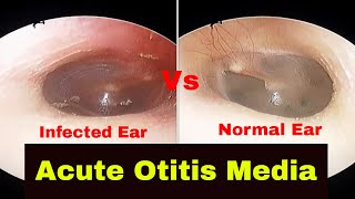 Acute Otitis Media  Diagnosis and Treatment [upl. by Petromilli523]