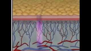 Phases of Wound Healing Pt 2  Wound Care Management  WoundEducatorscom [upl. by Birck102]