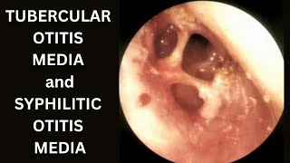 Tubercular Otitis Media  Syphilitic Otitis Media [upl. by Priscella]