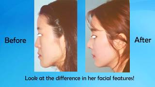 BSSO Bilateral Sagittal Split Osteotomy Surgery Procedure  Lower Jaw amp Orthognathic Surgery [upl. by Trina981]