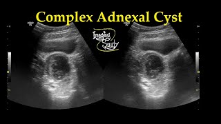 Complex Adnexal Cyst  Ultrasound  Case 27 [upl. by Anile]