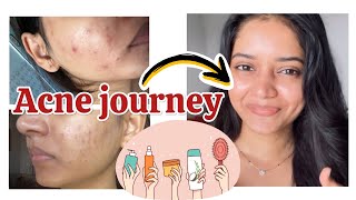 Severe ACNE cure journey in budget🥰❤️🤑 [upl. by Iidnarb]