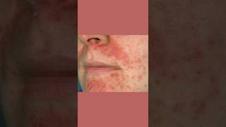 Why Your Perioral Dermatitis Won’t Heal dermatologist [upl. by Ojeibbob]