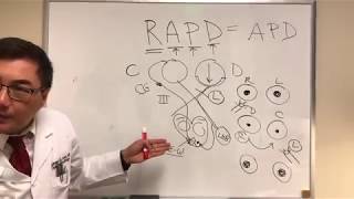 RAPD Relative Afferent Pupillary Defect MarcusGunn pupil [upl. by Arraeis]