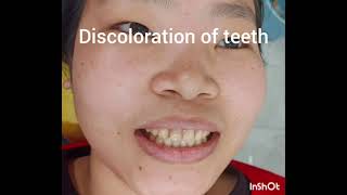 treatment of discolored teeth by veneers [upl. by Hulbert]