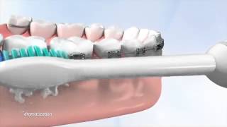 Tips on how use a Philips Sonicare toothbrush with braces Hygiene is a key part of daily care [upl. by Ludewig]