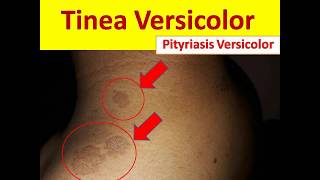 Tinea Versicolor in Young People  Pityriasis Versicolor [upl. by Vidovic]