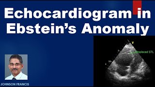 Echocardiogram in Ebsteins Anomaly of Tricuspid Valve [upl. by Charie]