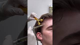 PRP treatment for hair thinning [upl. by Adnarom486]